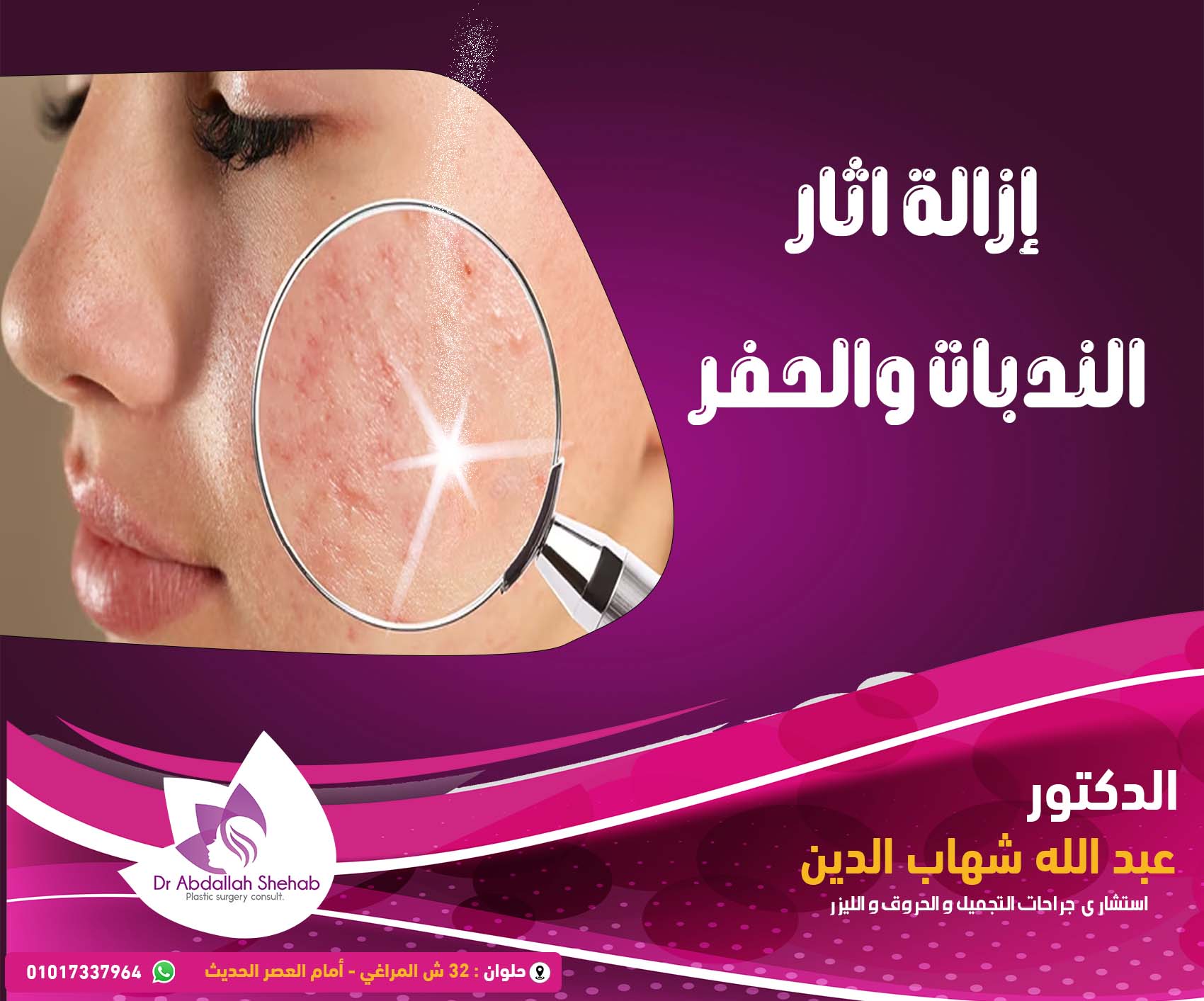 إزالة آثار الندبات